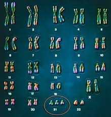 trissomia-do-cromossomo-21-1